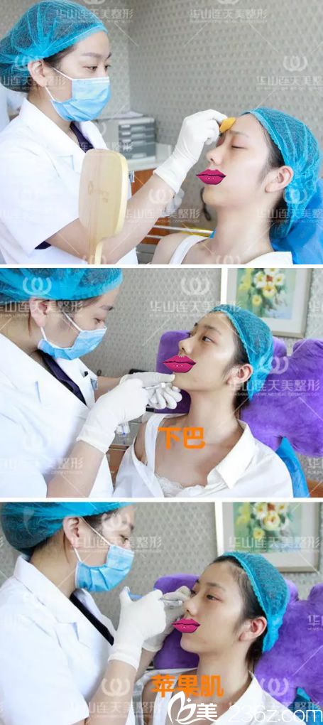 玻尿酸填充下巴和蘋果肌過程 玻尿酸填充下巴和蘋果肌過程