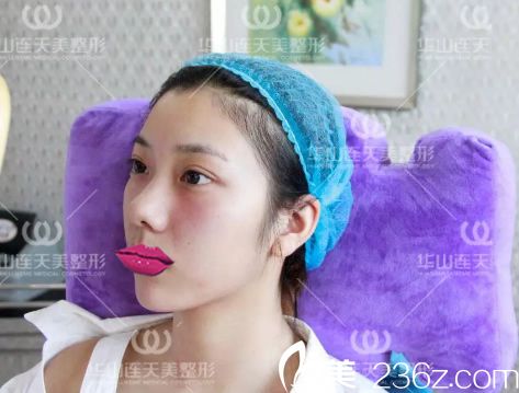 注射玻尿酸填充手術即刻效果 注射玻尿酸填充手術即刻效果