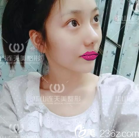 玻尿酸填充手術第1天效果 玻尿酸填充手術第1天效果