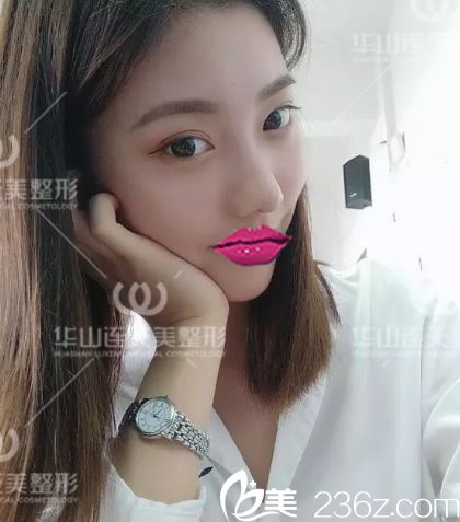 注射下巴酸第4天照片 注射下巴酸第4天照片