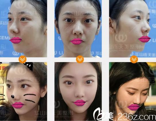 連天美李大琦玻尿酸案例 連天美李大琦玻尿酸案例