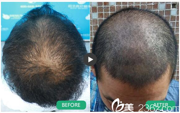 廣州倍生植發(fā)醫(yī)院廖駿頭頂毛發(fā)加密案例