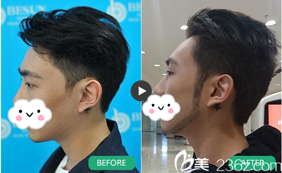 廣州倍生植發(fā)醫(yī)院廖駿絡(luò)腮胡須種植案例