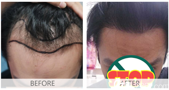 廣州倍生植發(fā)醫(yī)院楊曉男士發(fā)際線種植案例