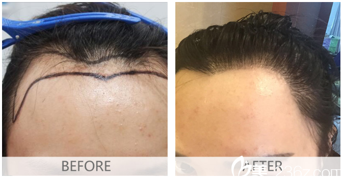 廣州倍生植發(fā)醫(yī)院楊曉女士發(fā)際線種植案例