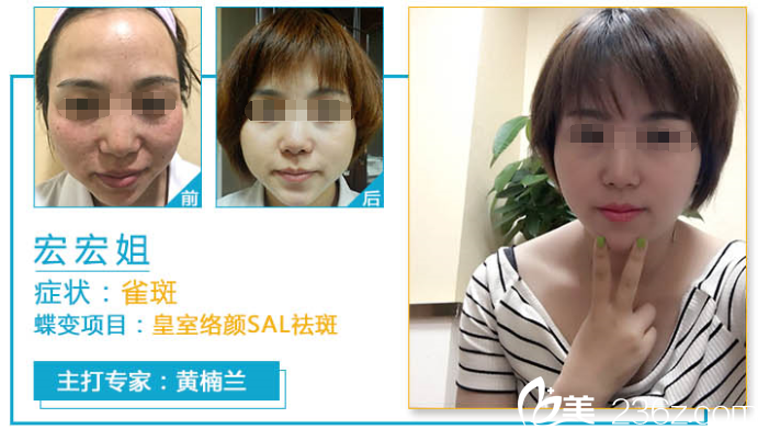 成都軍建醫(yī)院黃楠蘭去雀斑案例