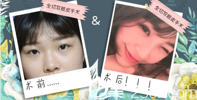 王先松全切雙眼皮術前術后對比照