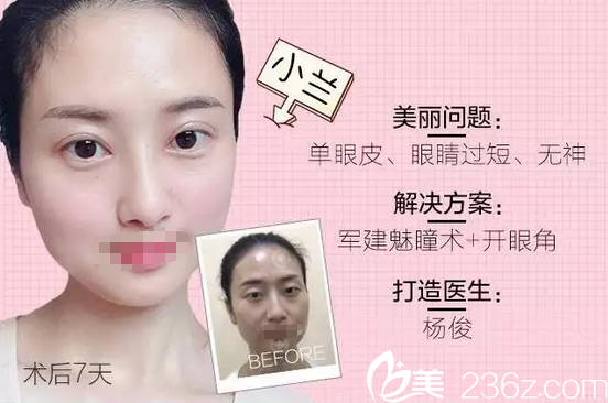 成都軍建醫(yī)院整形美容中心雙眼皮對比照 成都軍建醫(yī)院整形美容中心雙眼皮對比照