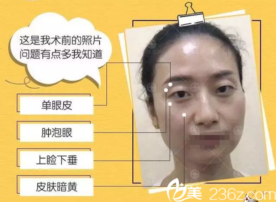 雙眼皮+開眼角術(shù)前照片 雙眼皮+開眼角術(shù)前照片