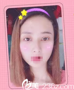 雙眼皮+開眼角術(shù)后1天照片 雙眼皮+開眼角術(shù)后1天照片