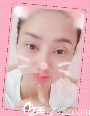 <!--<i data=20240703-sp></i>-->雙眼皮術(shù)后3天恢復(fù)情況 <!--<i data=20240703-sp></i>-->雙眼皮術(shù)后3天恢復(fù)情況