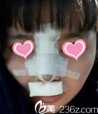 剛做完鼻綜合手術(shù)的樣子