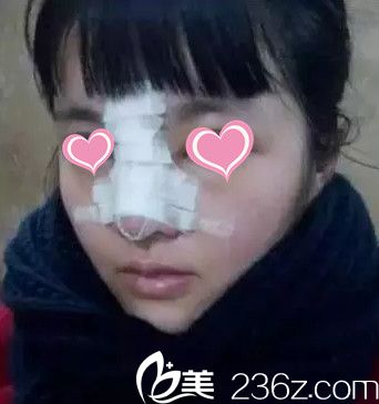 術(shù)后第3天鼻子腫脹厲害