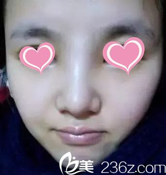 做完鼻綜合手術(shù)7天拆線后的樣子