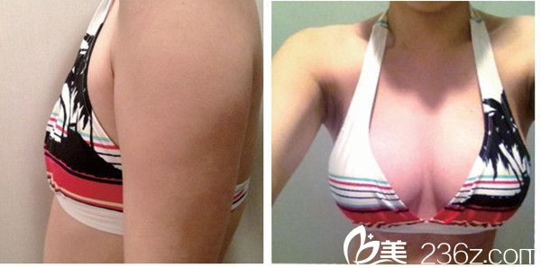 鄭景仁院長(zhǎng)假體隆胸案例 鄭景仁院長(zhǎng)假體隆胸案例