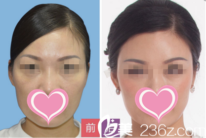 面部年輕化手術(shù)效果