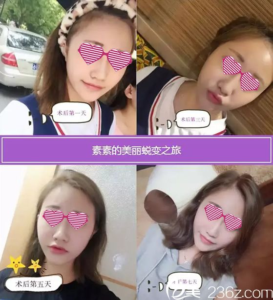 注射玻尿酸填充術后7天恢復過程圖 注射玻尿酸填充術后7天恢復過程圖