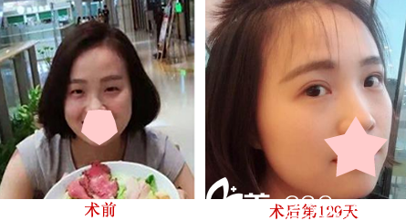 崔勁松整形案例—眼部綜合前后圖 崔勁松整形案例—眼部綜合前后圖