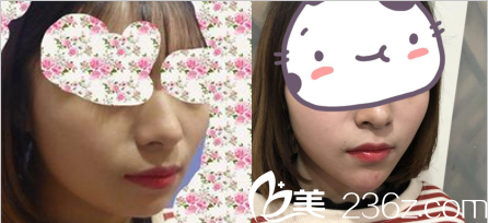 合肥崔勁松玻尿酸隆下巴前后對比照片 合肥崔勁松玻尿酸隆下巴前后對比照片