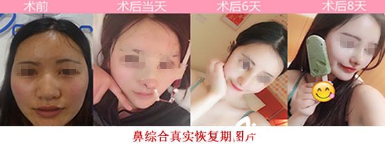 合肥崔向葵整形整形怎么樣？看鼻綜合案例對比圖