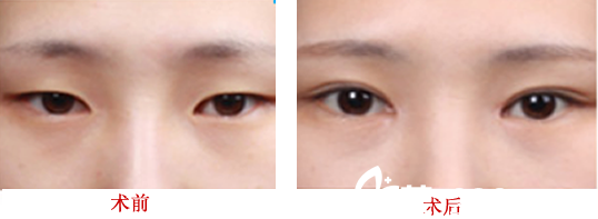 醫(yī)生崔向葵做雙眼皮好嗎？雙眼皮整形案例對比圖展示