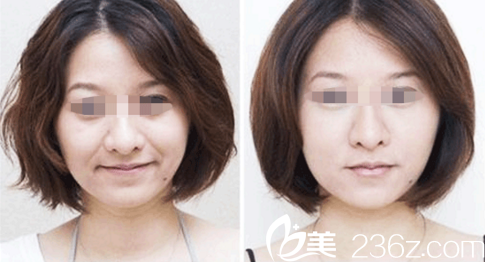 注射除皺效果對比 注射除皺效果對比