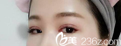 眼部修復整形術后第7天樣子 眼部修復整形術后第7天樣子