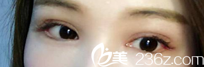 直播我找合肥崔勁松整形崔向葵做雙眼皮失敗修復真實過程