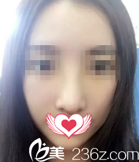 術(shù)后一周拆線