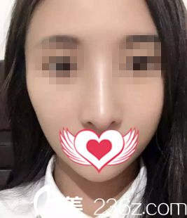 術(shù)后20天效果