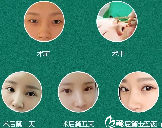 王章霞醫(yī)生雙眼皮案例