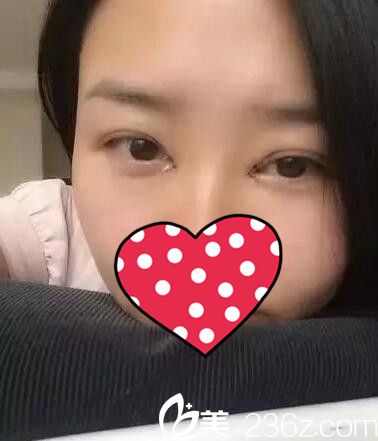 眼綜合術(shù)后三天恢復(fù) 眼綜合術(shù)后三天恢復(fù)