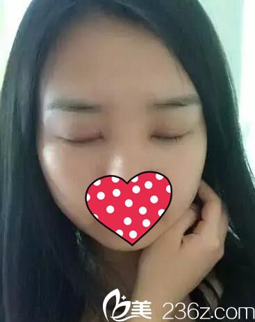 拆線后雙眼皮效果 拆線后雙眼皮效果