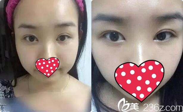 雙眼皮+開眼角術(shù)后十天 雙眼皮+開眼角術(shù)后十天