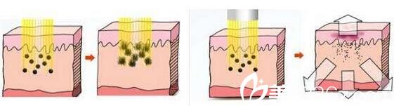 南寧韓星整形激光美容原理 南寧韓星整形激光美容原理