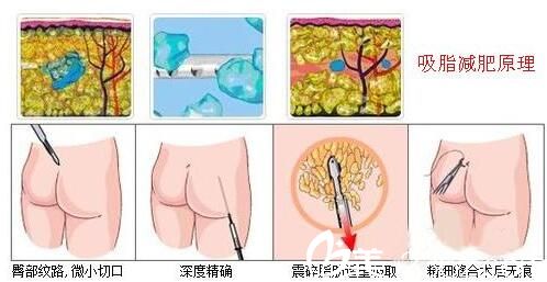 南寧韓星講解吸脂手術原理