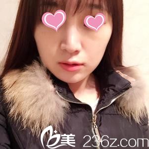 找愛膚愛福整形外科張誠洙院長打了瘦臉除皺瘦臉，妹子瞬間變女神