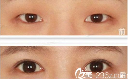 蘭州亞韓謝雯雙眼皮整形效果