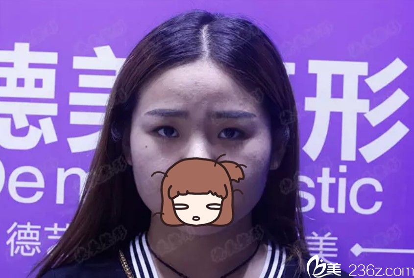 看我找整形李倩做的雙眼皮+開眼角20天后變化大嗎？