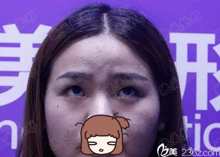 術(shù)前正面照