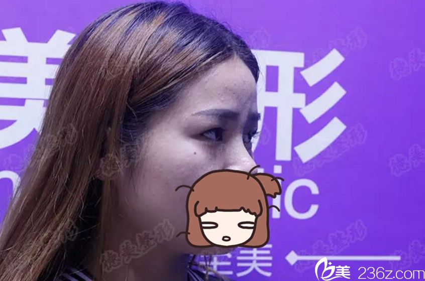 術(shù)前側(cè)面照