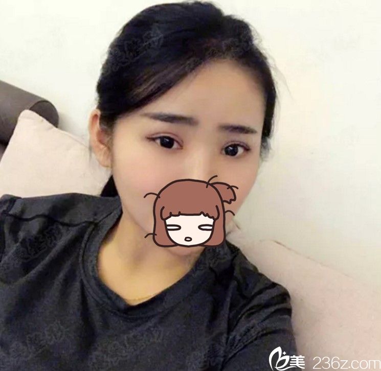 術(shù)后2個月正面