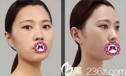 在南寧韓星做眼鼻綜合+自體脂肪填充全臉前 在南寧韓星做眼鼻綜合+自體脂肪填充全臉前