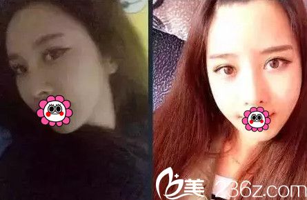 在南寧韓星找院長(zhǎng)花87900元做眼鼻綜合+自體脂肪填充全面部過(guò)程