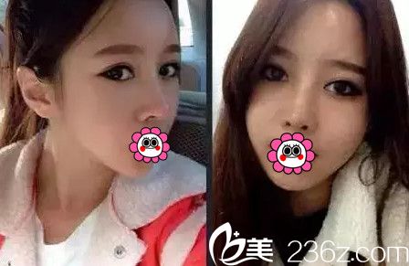 在南寧韓星做眼鼻綜合+自體脂肪填充全臉術(shù)后1個月 在南寧韓星做眼鼻綜合+自體脂肪填充全臉術(shù)后1個月