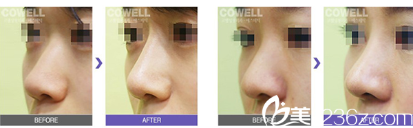 姜昌均院長鼻綜合手術(shù)案例 姜昌均院長鼻綜合手術(shù)案例