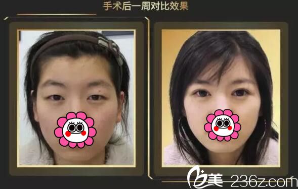 張東波醫(yī)生雙眼皮案例 張東波醫(yī)生雙眼皮案例