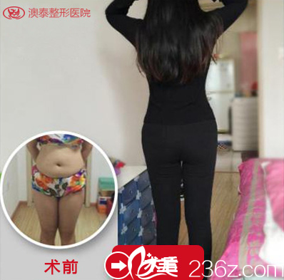 湛江澳泰整形醫(yī)院吸脂案例對比圖