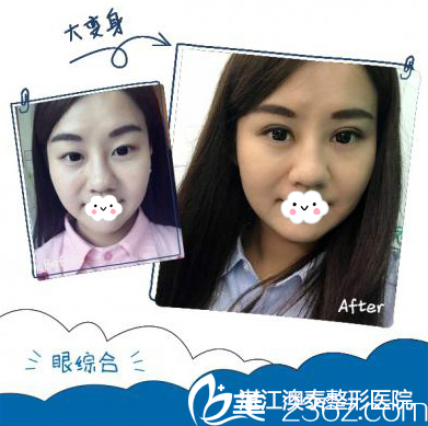 湛江澳泰整形醫(yī)院雙眼皮案例對比圖