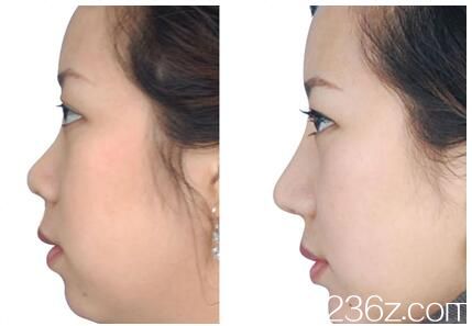 湛江澳泰整形醫(yī)院隆鼻案例